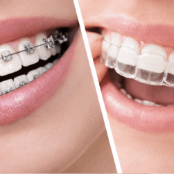 Orthodontic Treatment